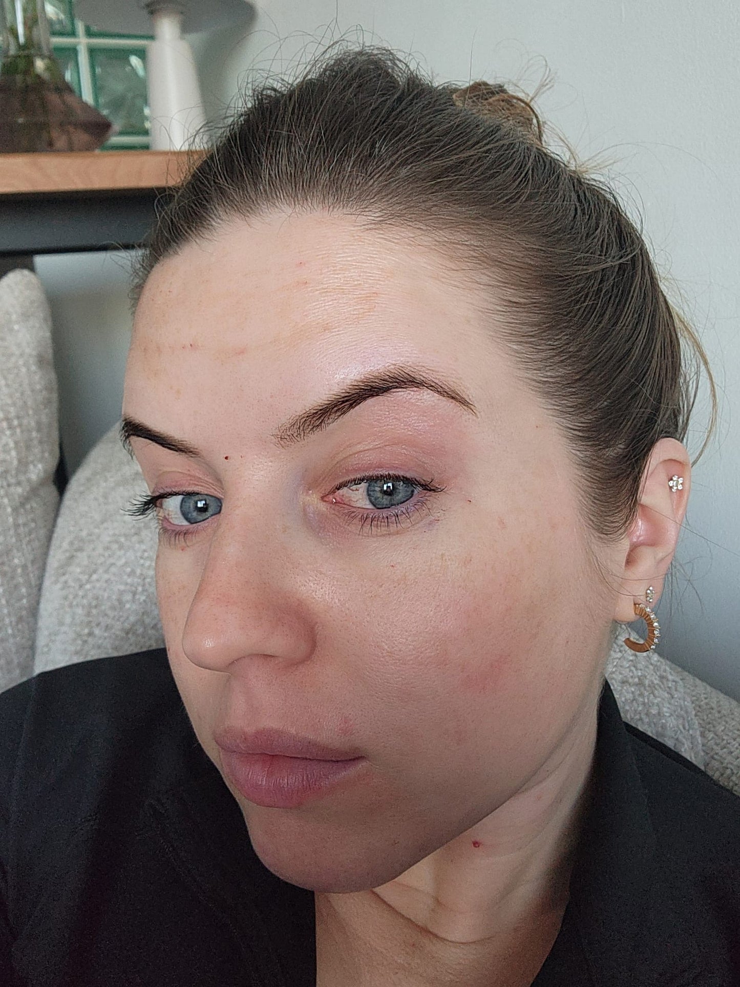 Skin booster Undereye