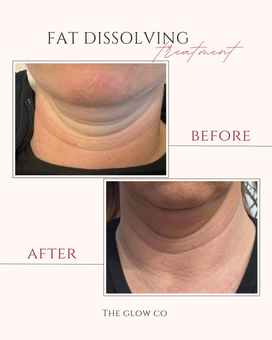 Fat dissolving treatment