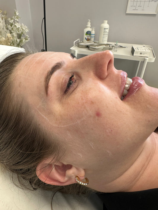 Skin booster Undereye