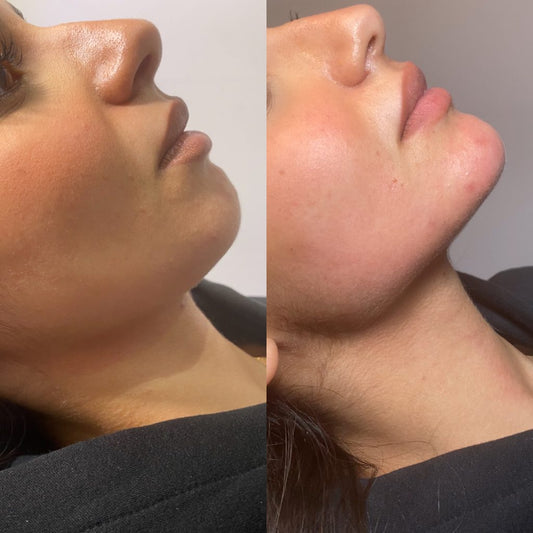 Dermal Filler