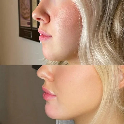 Dermal Filler