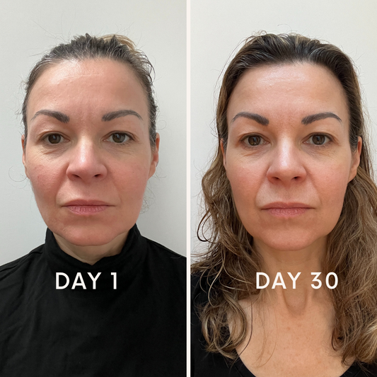 Medical Microneedling with exosomes