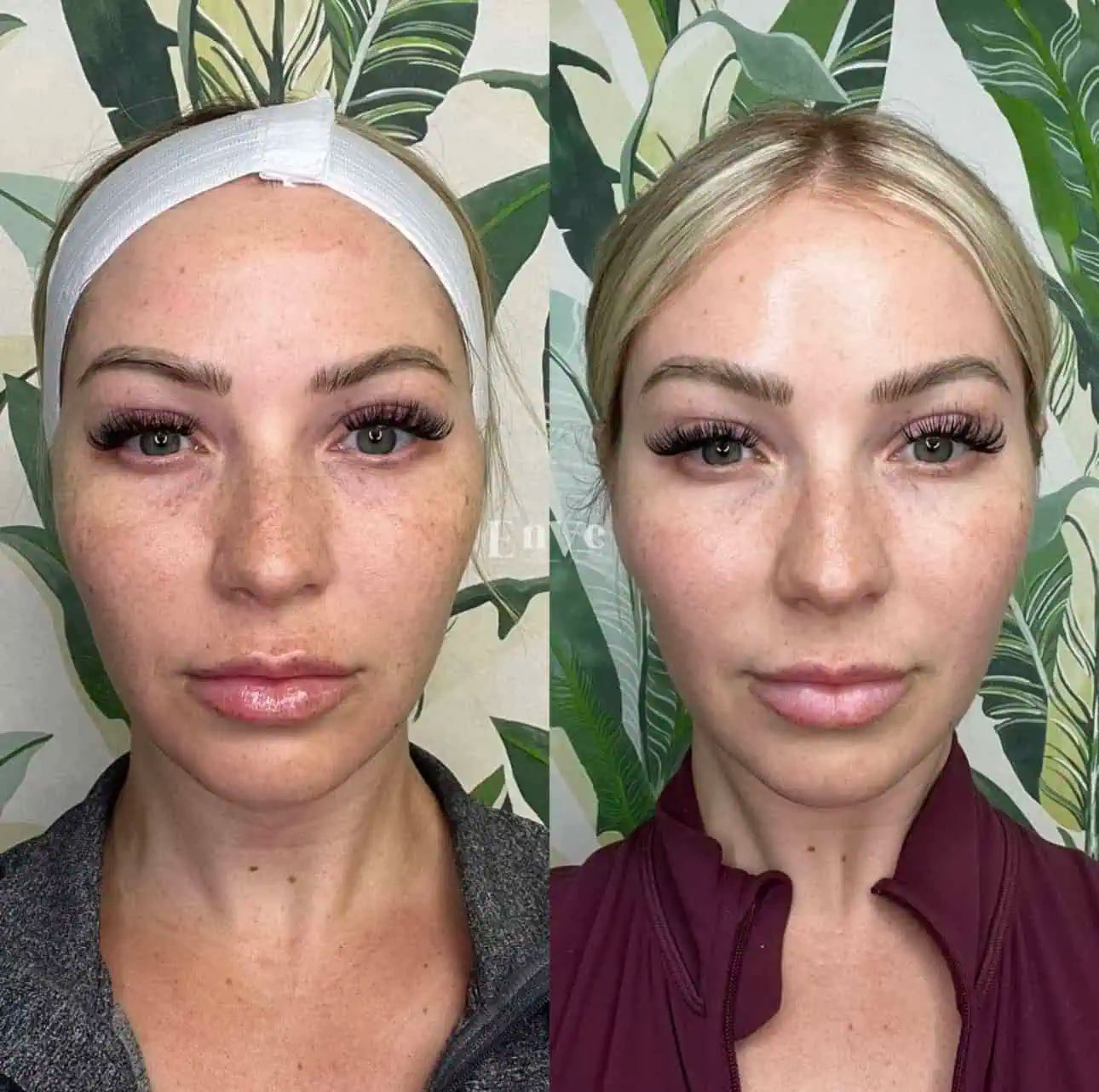 Medical Microneedling with exosomes