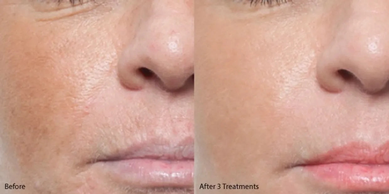 Medical Microneedling with exosomes