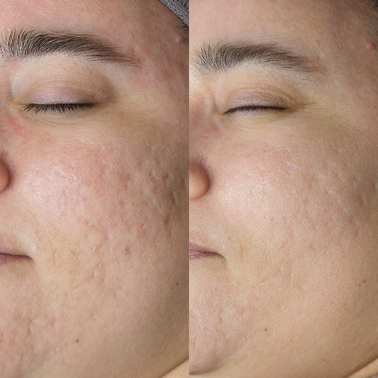 Medical Microneedling