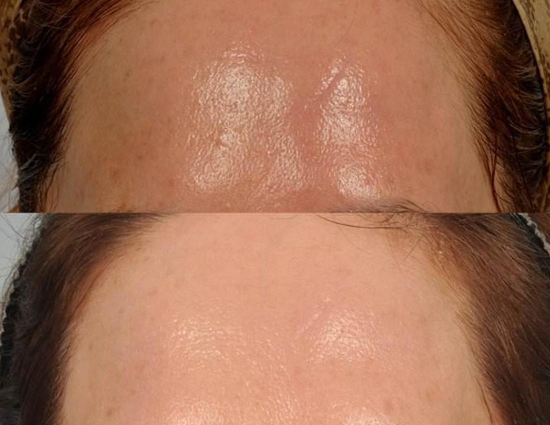 Medical Microneedling
