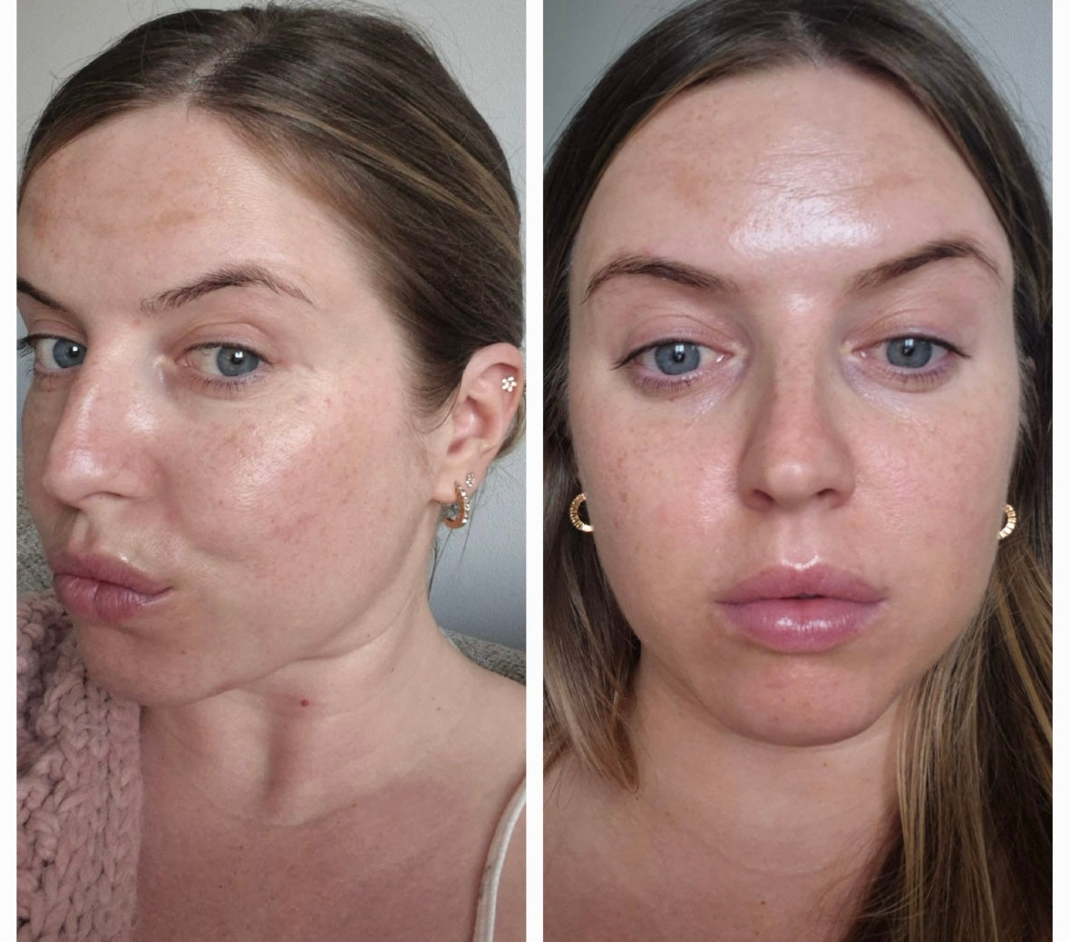 Medical Microneedling