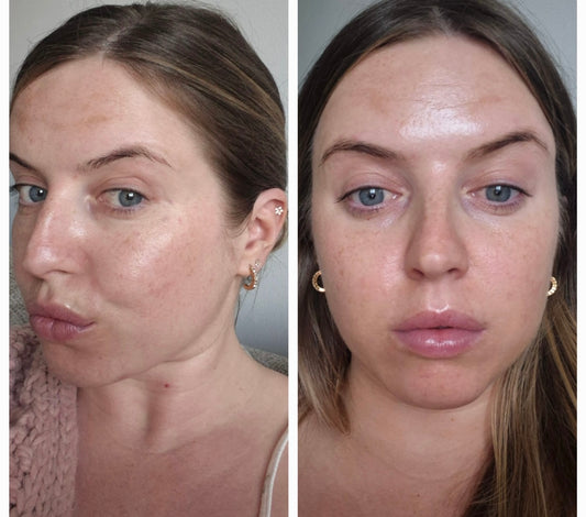 Medical Microneedling