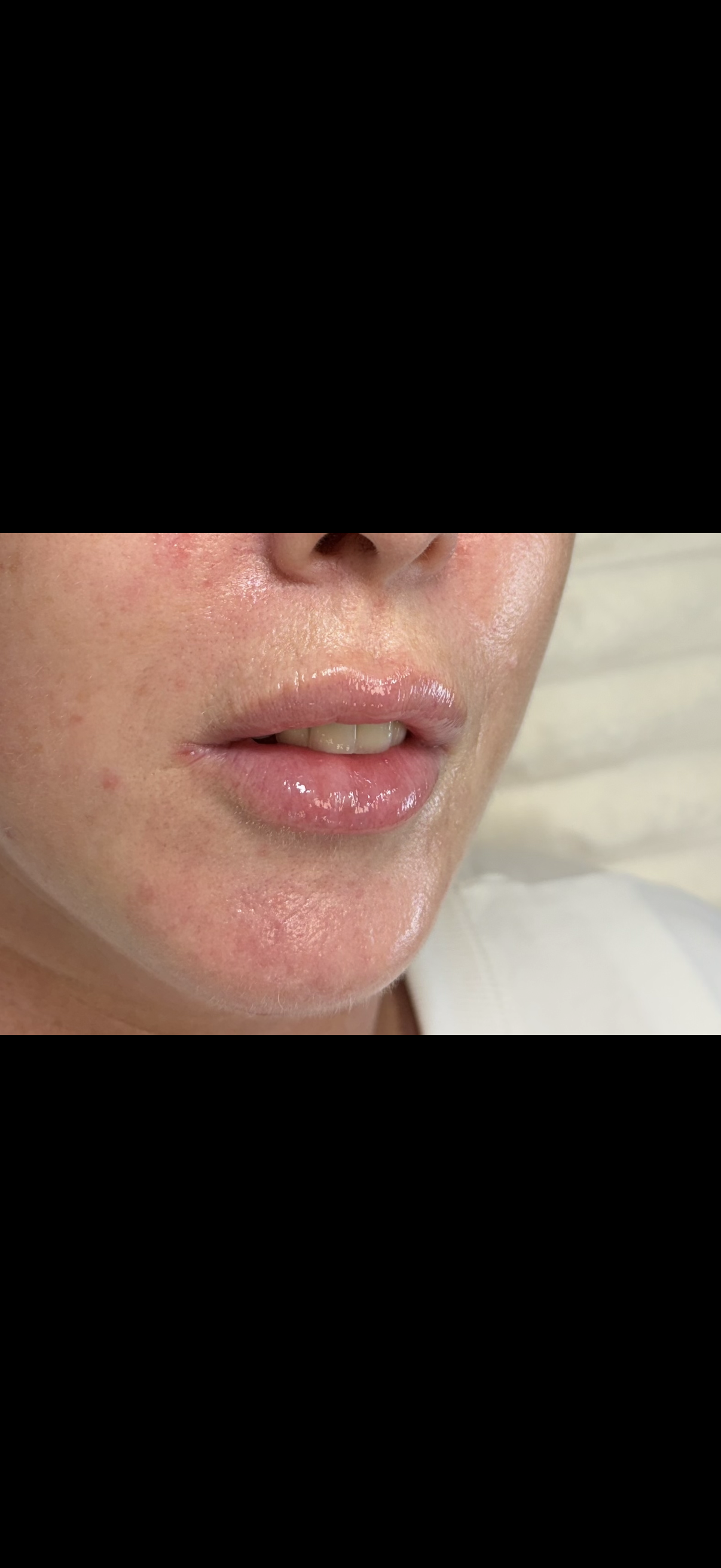Dermal Filler