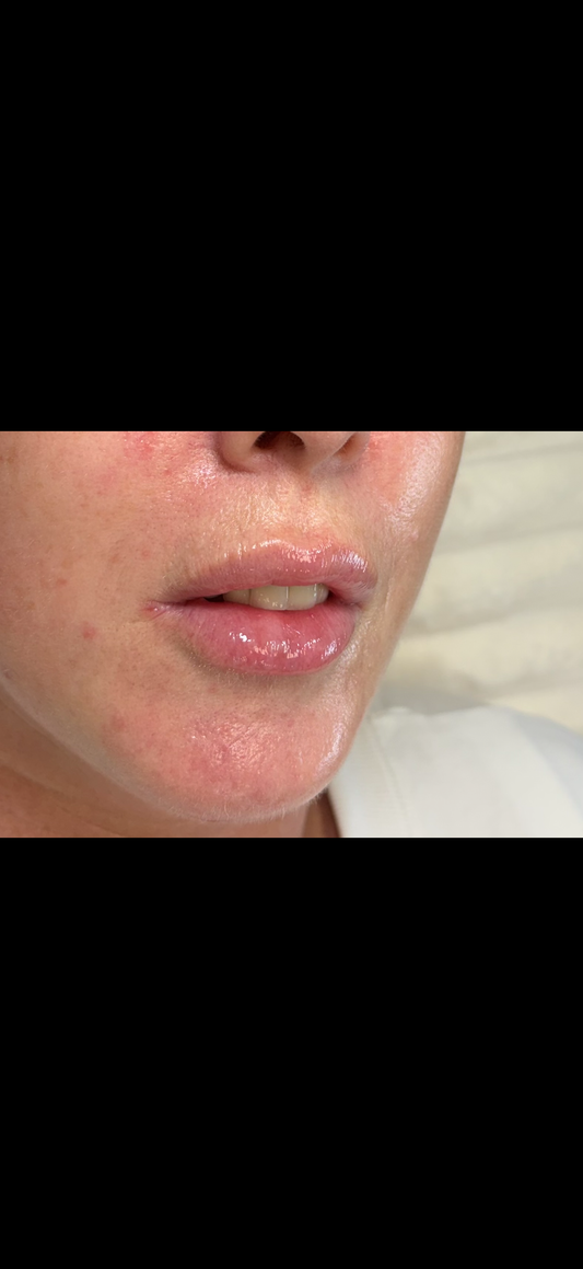 Dermal Filler