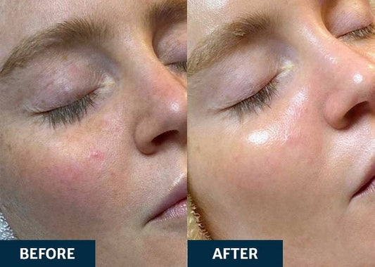 Hydrafacial