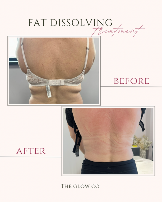 Fat dissolving treatment