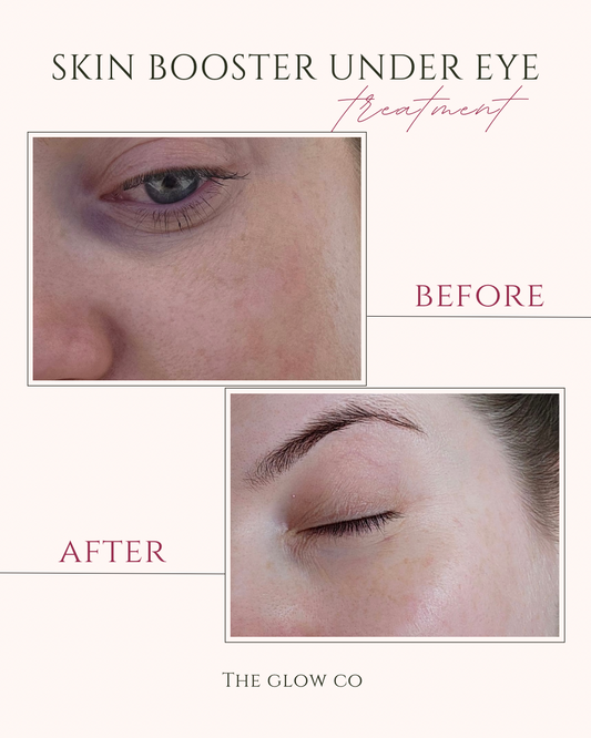 Skin booster Undereye