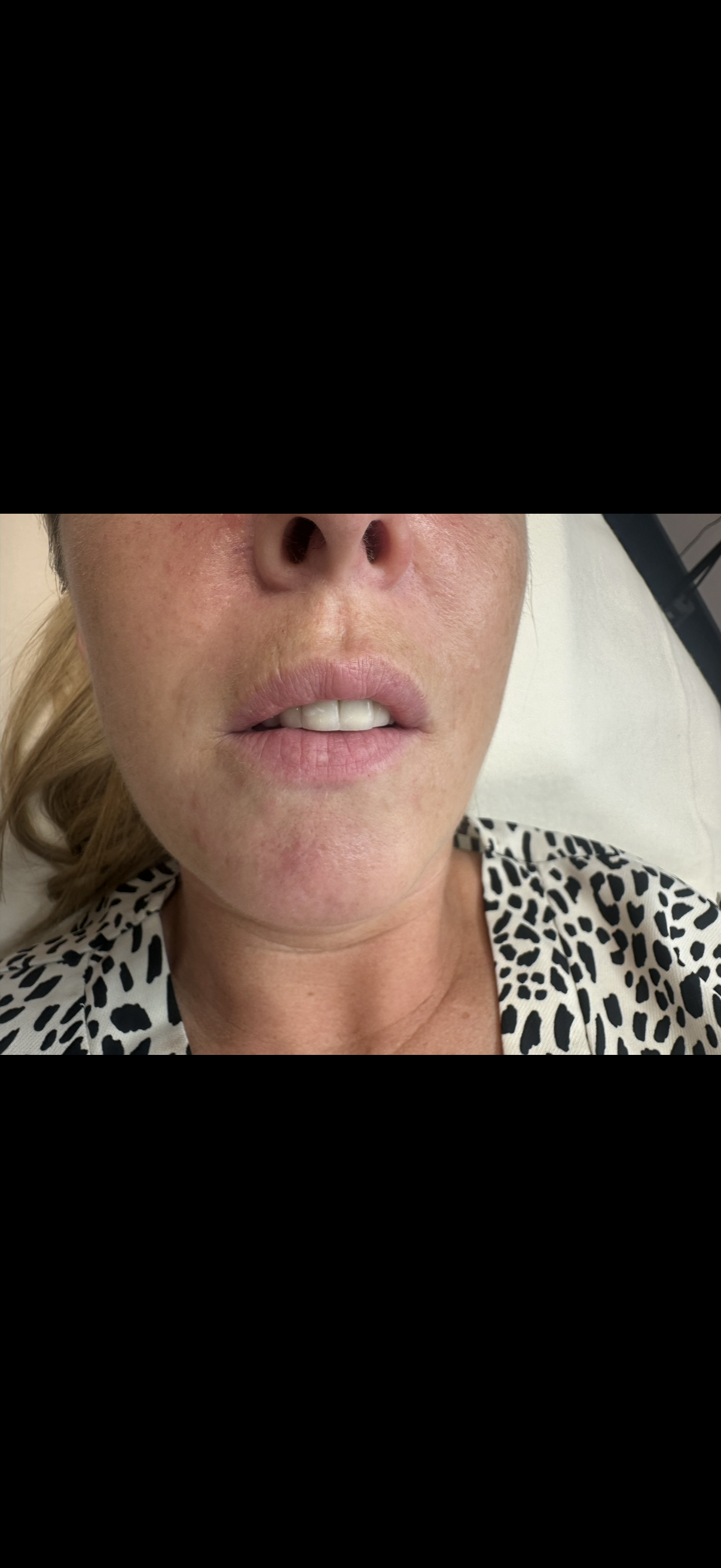 Dermal Filler