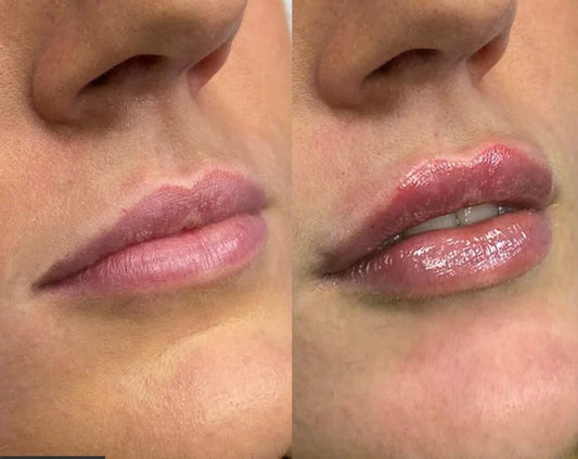 Dermal Filler