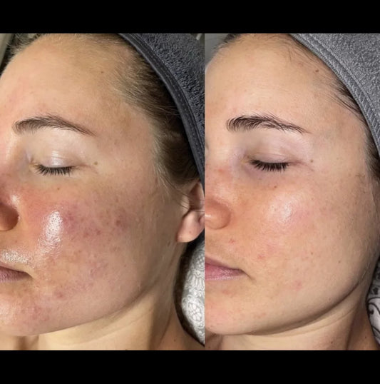 Medical Microneedling with exosomes