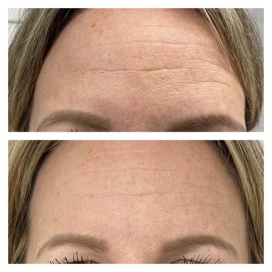 Medical Microneedling